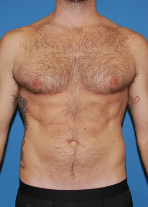 abdominal etching after surgery at XSculpt Chicago, case 12101