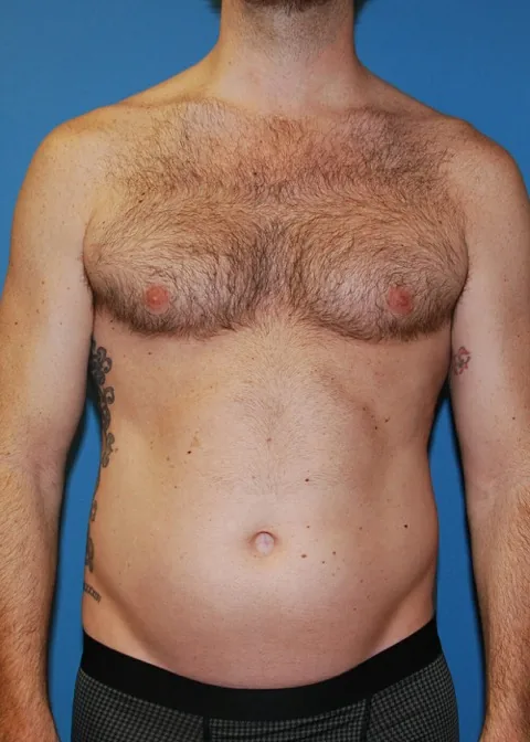 abdominal etching before surgery at XSculpt Chicago, case 12101