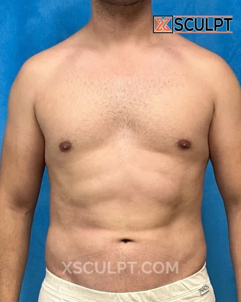 abdominal etching (vaser lipo) after surgery at XSculpt Chicago, case 1638367