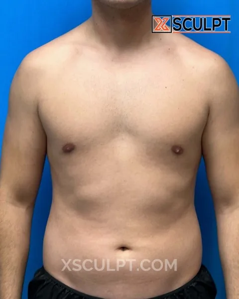 abdominal etching (vaser lipo) before surgery at XSculpt Chicago, case 1638367