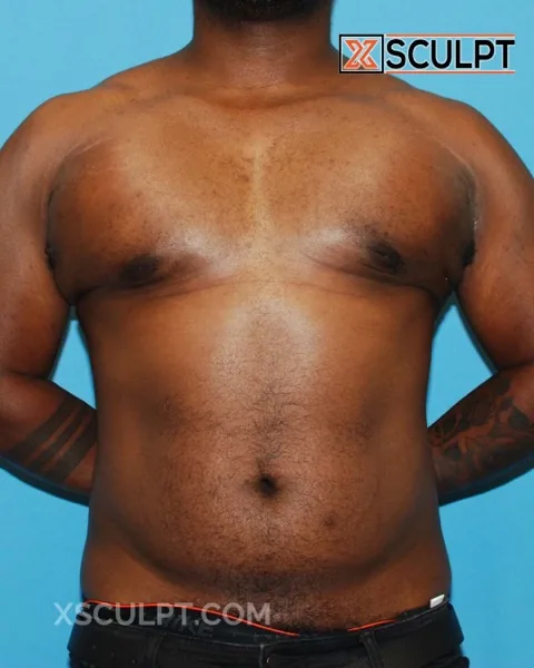 bodybuilder gynecomastia after surgery at XSculpt Chicago, case 1047260