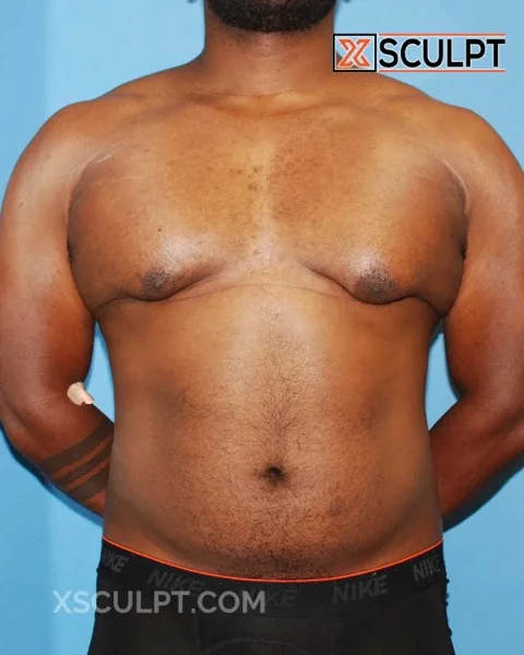 bodybuilder gynecomastia before surgery at XSculpt Chicago, case 1047260