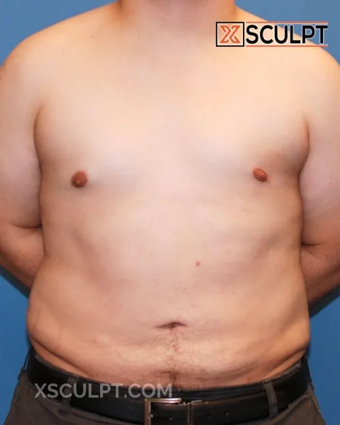 grade 1 gynecomastia after surgery at XSculpt Chicago, case 1220290
