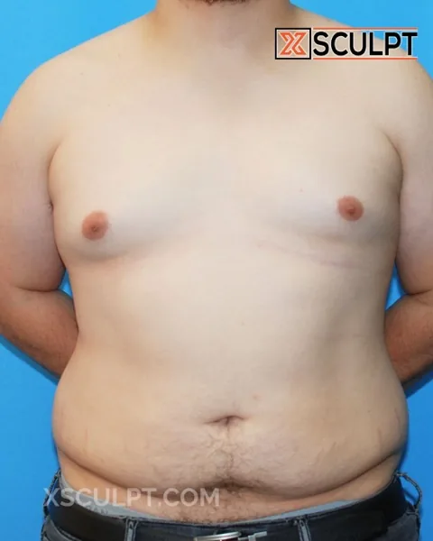 grade 1 gynecomastia before surgery at XSculpt Chicago, case 1220290