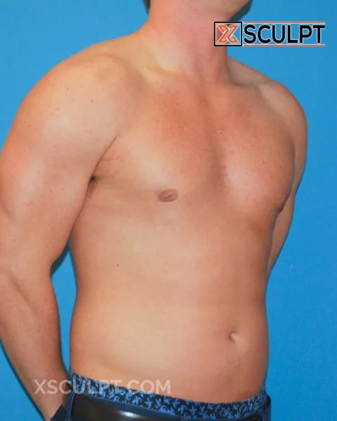 grade 1 gynecomastia after surgery at XSculpt Chicago, case 26000