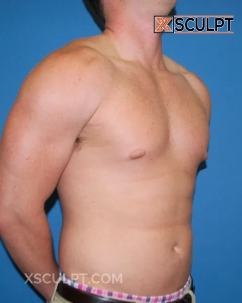 grade 1 gynecomastia before surgery at XSculpt Chicago, case 26000