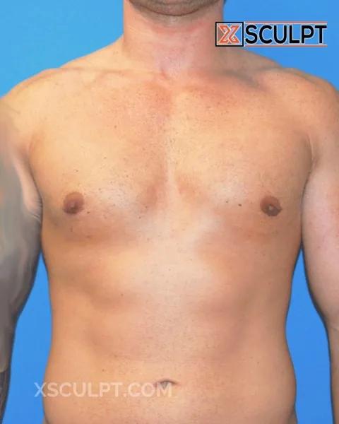 grade 2 gynecomastia after surgery at XSculpt Chicago, case 16000