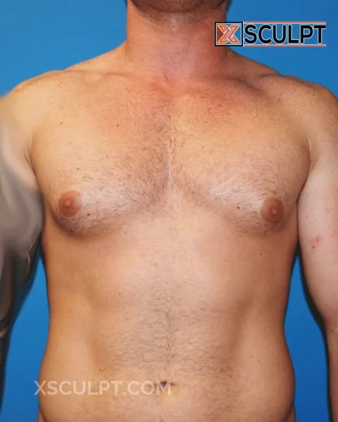 grade 2 gynecomastia before surgery at XSculpt Chicago, case 16000