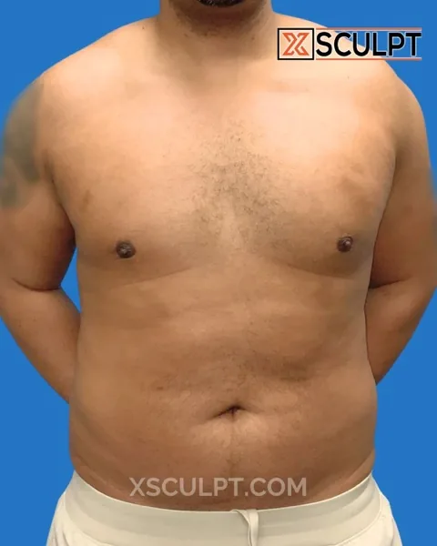 grade 2 gynecomastia after surgery at XSculpt Chicago, case 1994630