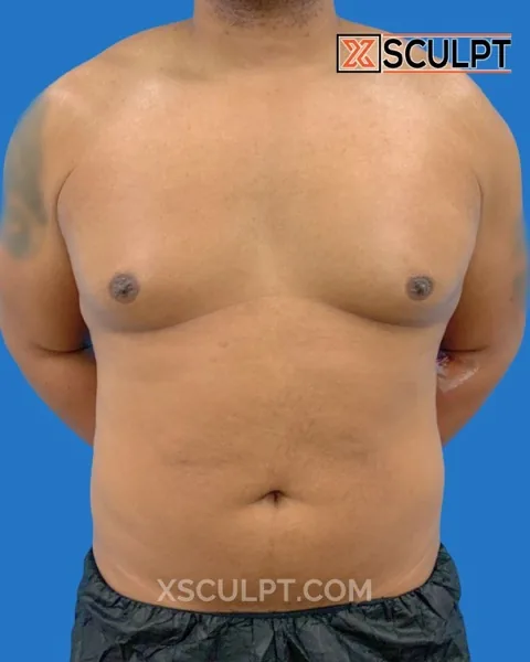 grade 2 gynecomastia before surgery at XSculpt Chicago, case 1994630