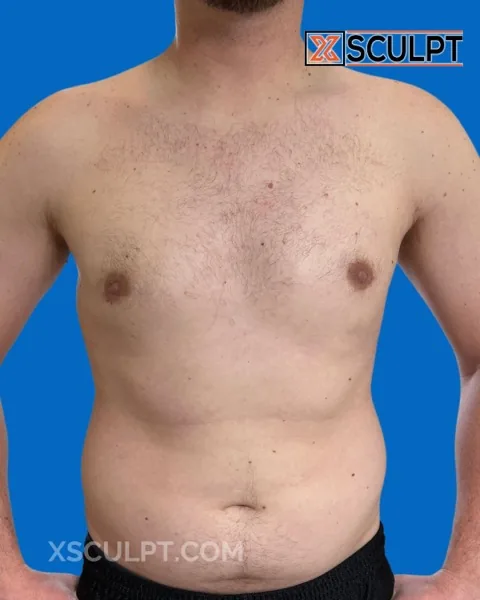 grade 2 gynecomastia after surgery at XSculpt Chicago, case 2327176