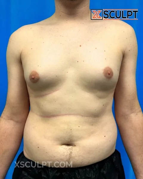 grade 2 gynecomastia before surgery at XSculpt Chicago, case 2327176