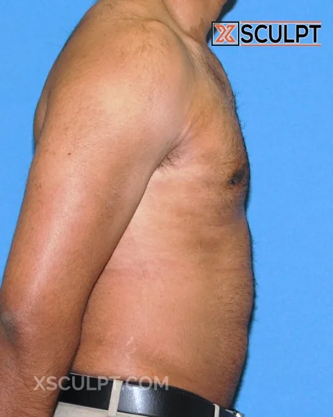 grade 2 gynecomastia after surgery at XSculpt Chicago, case 50000