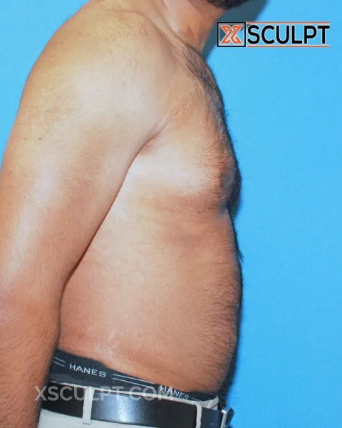 grade 2 gynecomastia before surgery at XSculpt Chicago, case 50000
