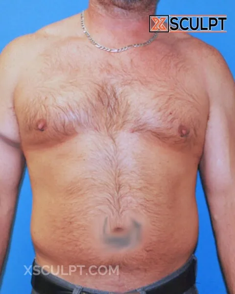 grade 3 gynecomastia after surgery at XSculpt Chicago, case 11000