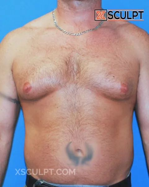grade 3 gynecomastia before surgery at XSculpt Chicago, case 11000