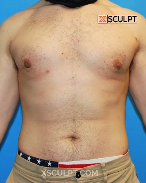 grade 3 gynecomastia after surgery at XSculpt Chicago, case 1540411