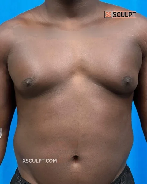 grade 3 gynecomastia before surgery at XSculpt Chicago, case 1971489