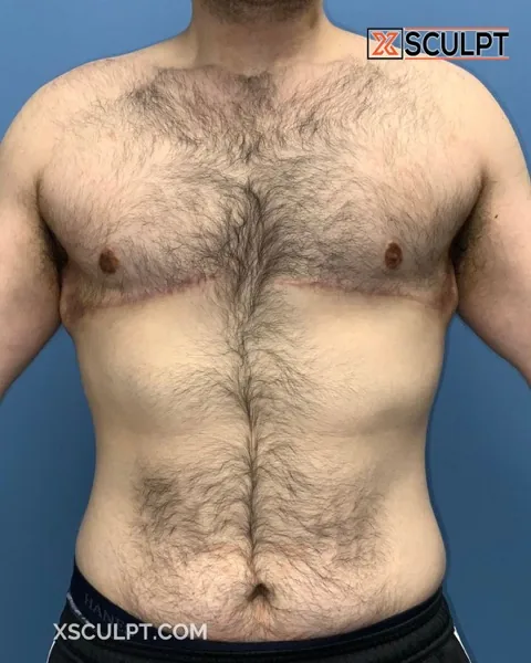 grade 4 gynecomastia after surgery at XSculpt Chicago, case 1853159