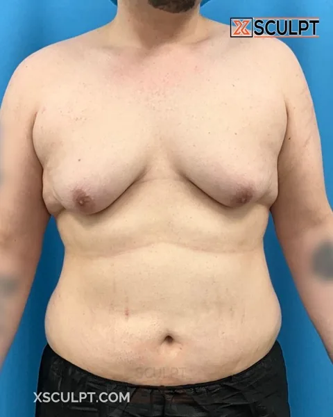 grade 4 gynecomastia before surgery at XSculpt Chicago, case 1853159