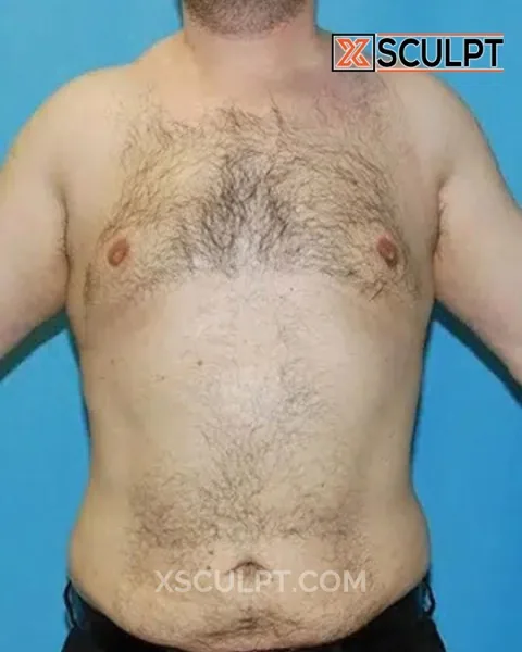 grade 4 gynecomastia after surgery at XSculpt Chicago, case 36276