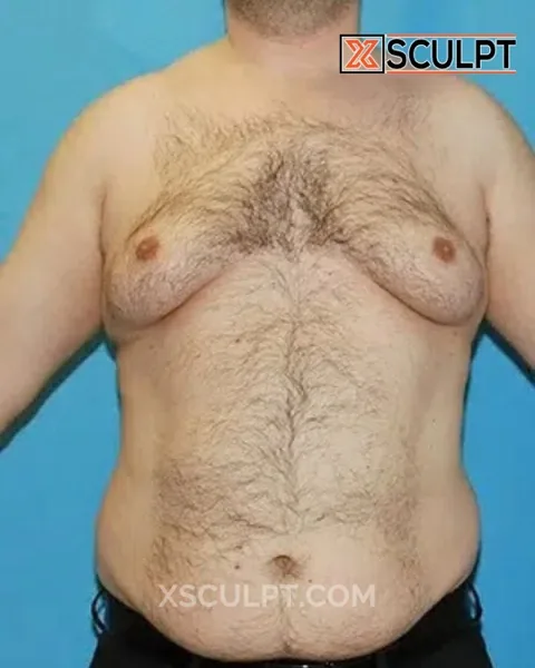 grade 4 gynecomastia before surgery at XSculpt Chicago, case 36276