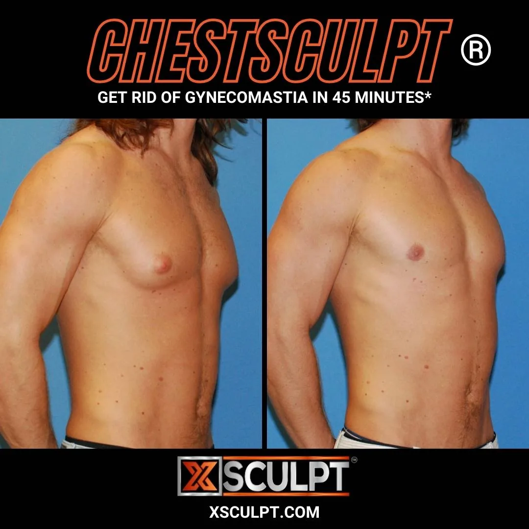 ChestSculpt gynecomastia before and after results, patient 1