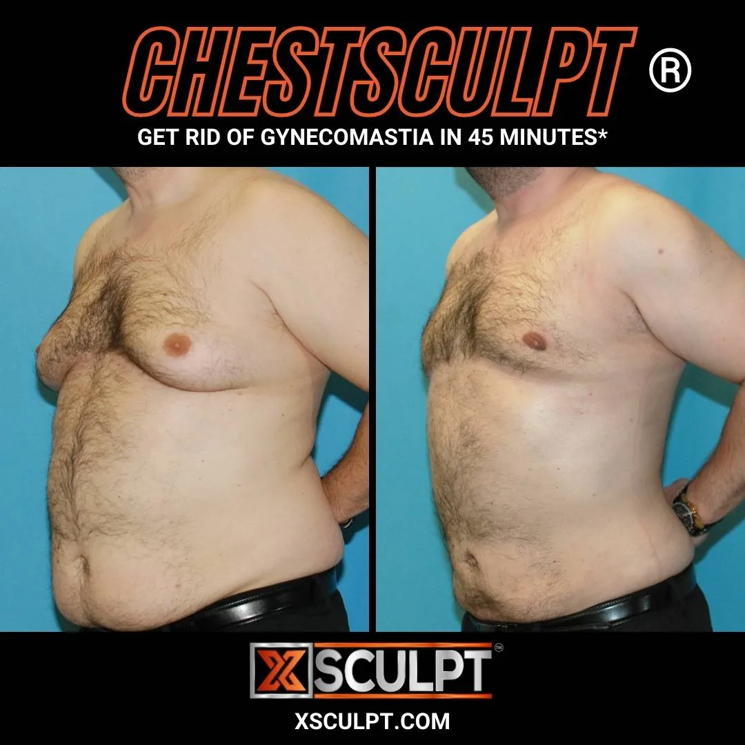 ChestSculpt gynecomastia before and after results, patient 2